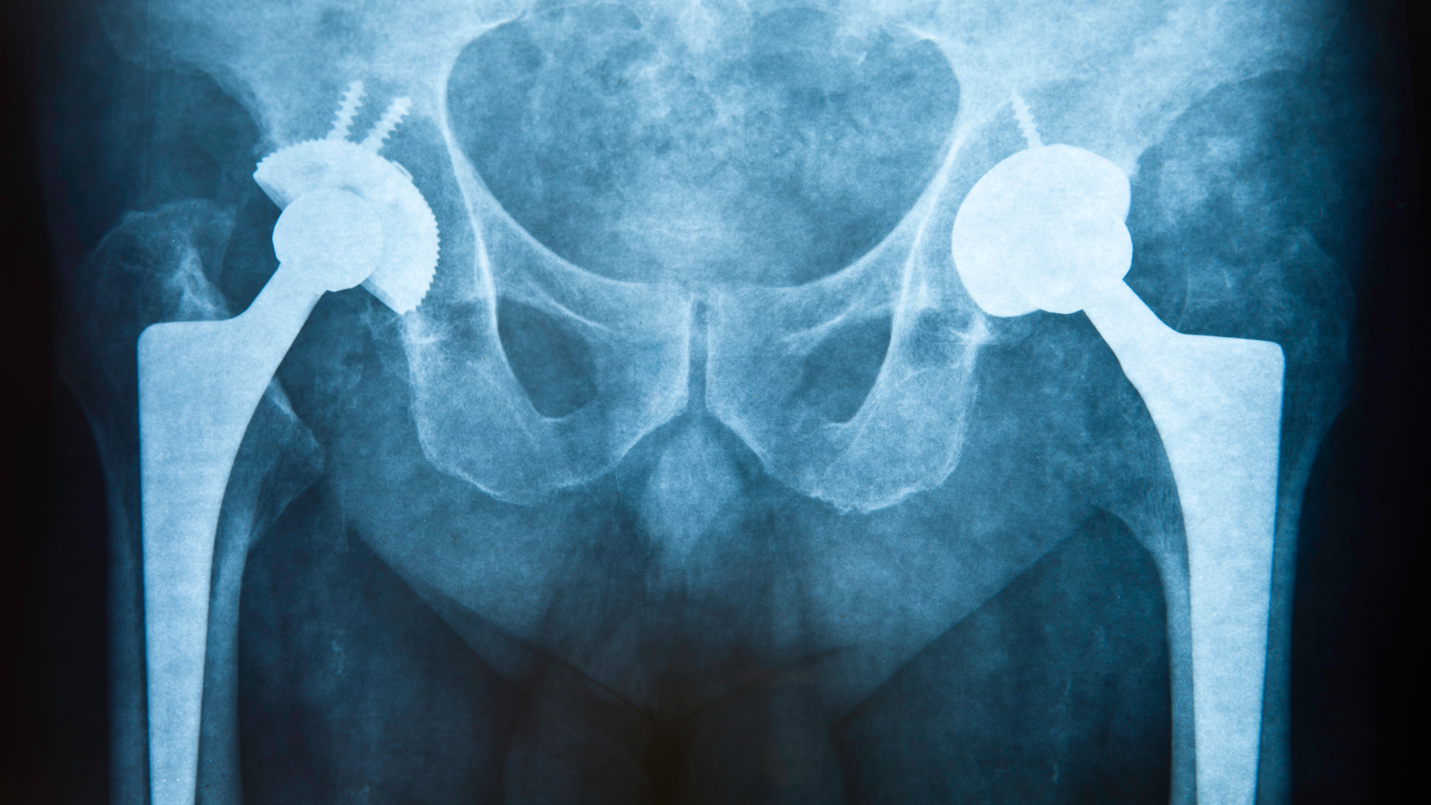 Image of a hip X-ray