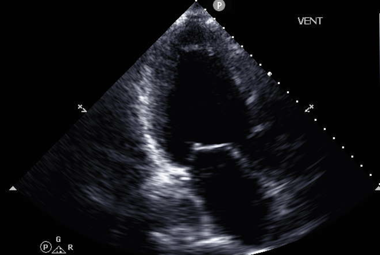 Example of echocardiographic image